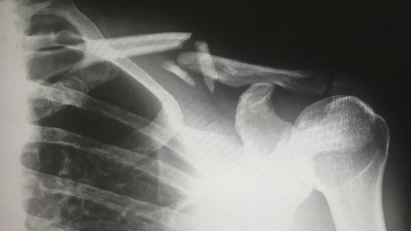 Exactech presents new AI and radiomic research for ortho uses